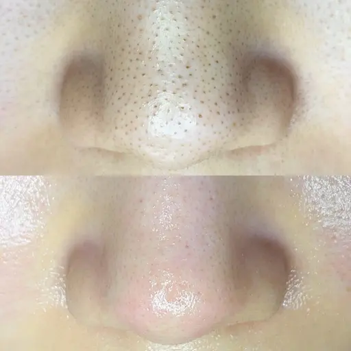 毛穴すっきりエクストラクション