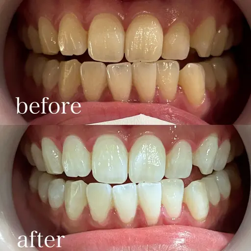 🦷20日🈷️限定🦷まずは定番のナチュラルホワイトニング😍✨【通常¥9900→初回¥1980❤️‍🔥】今だけ価格