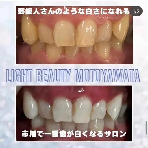 ✨初回限定·ナチュラルな白さ✨人間本来の自然な歯の白さを目指していきます😉✨〈10分×3回照射コース〉メンズも🆗‼️