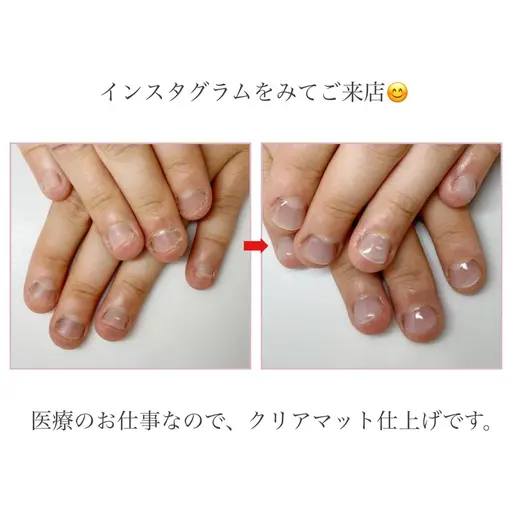 ネイルNGの方🍀深爪矯正|長さだし+美爪形成(クリアまたはマット仕上げ)