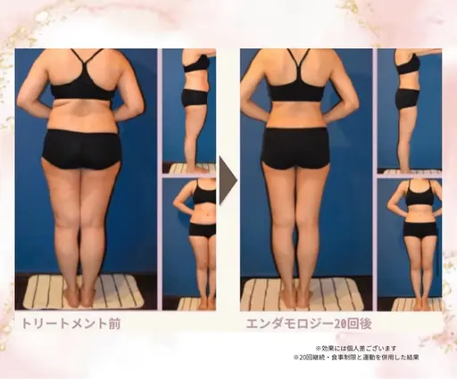 【初回限定】脂肪集中ケア・スッキリとした美ラインへ。エンダモロジーボディ50分＋10分延長サービス🎁