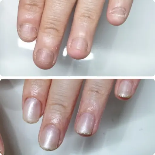 人前で見せられる指先へ💅|深爪矯正(長さ出し+ワンカラー)