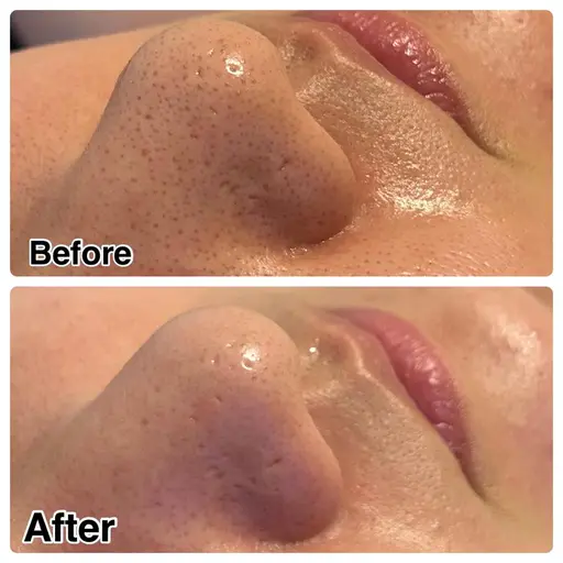 【ご新規様限定👑】黒ずみごっそり毛穴洗浄《脱黒ずみ／毛穴開き》