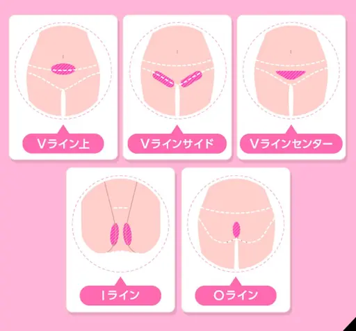 熱破壊式VIO脱毛🔥シェービング付き👏デザイン自由👑美白効果✨創業40年の実績効果❣