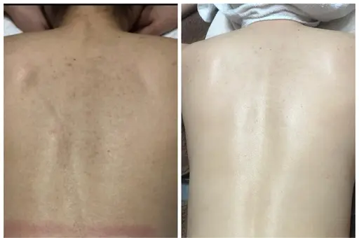 レディース全身脱毛すごくお得!!