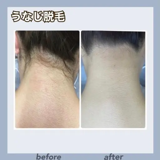 💎熱破壊式脱毛💎【うなじ・背中脱毛】形のご相談お任せください🙇🏻‍♀️完全シェービング付き❕IPLで抜け落ち抜群