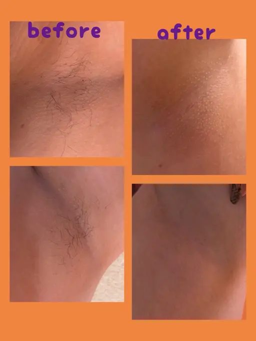 【両脇】男性女性どちらも歓迎！！ブラジリアンWaxまたは光脱毛🧡即日ツルツルへ✨※どちらかご希望の上、メッセージ下さい