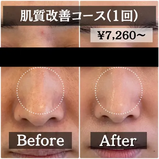 【ミニモ限定】開き/黒ずみ/たるみ毛穴 毛穴レスでツルスベ肌に♪肌質改善マッサージピール¥9,900→¥7,280