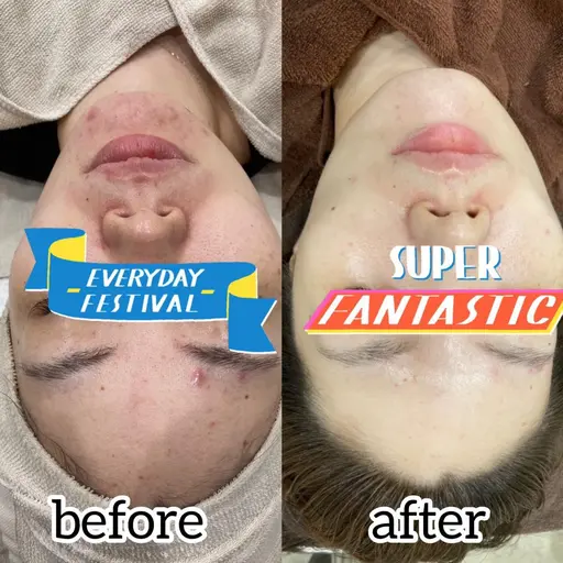 ♥️REVI ハーブピーリング継続したい方向け♥️剥離なしダウンタイムなし☆LINE登録で3回目まで30％OFF✨