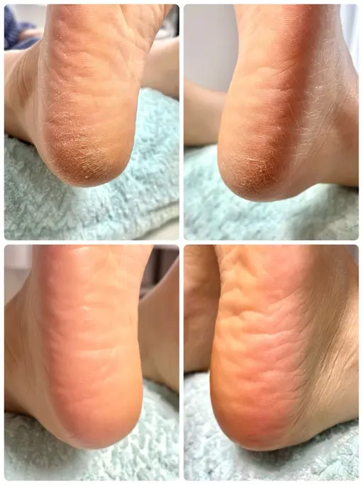 フット 角質ケア