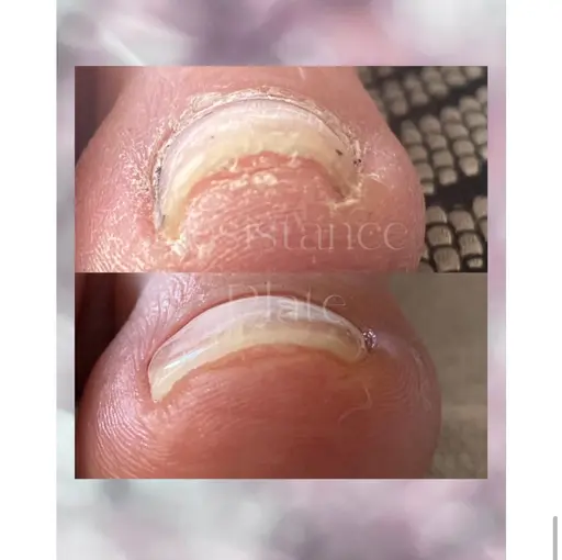 親指の巻き爪でお悩みの方必見！巻き爪矯正メニュースタート✨　ケア付き