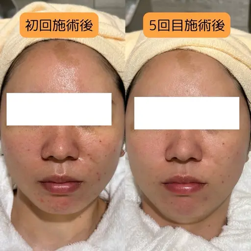 【人気No.１】お悩み別集中フェイシャルフルコース🫧¥5,500（税込）｜約75分