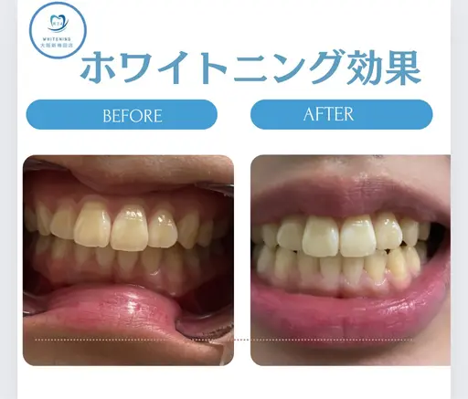 本日5月10日(日)1880円セルフホワイトニング🦷:(梅田最安値)先着2名20分照射当日直前予約🉑