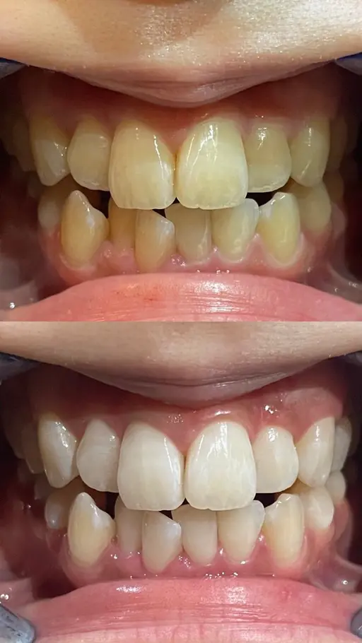 【歯の黄ばみに🦷】まずはお試し👍“8分×3回”で透明感ある自然な歯に!人目を気にせず自分磨き💖ホワイトニング🦷