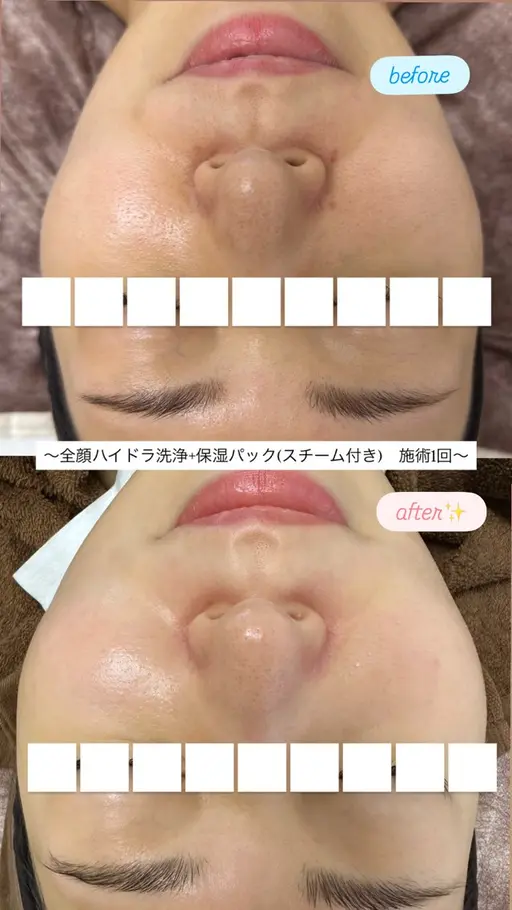 【ご新規様】毛穴つまり・ざらつきに✨全顔ピーリング+ハイドラ毛穴洗浄+保湿パック✨(スチーマー使用🪄)