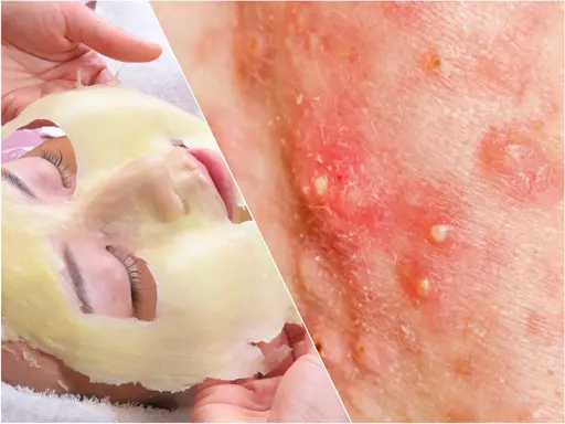 【肌質改善コース】ニキビケア