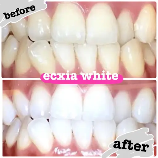 【中央区or日本橋在住/勤務の方限定】地域応援セルフホワイトニング★¥8,800→¥1000円