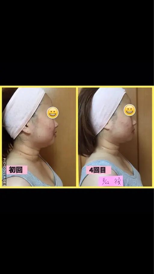 小顔キャビテーション＋顔筋コルギマッサージ＋お悩み別パック