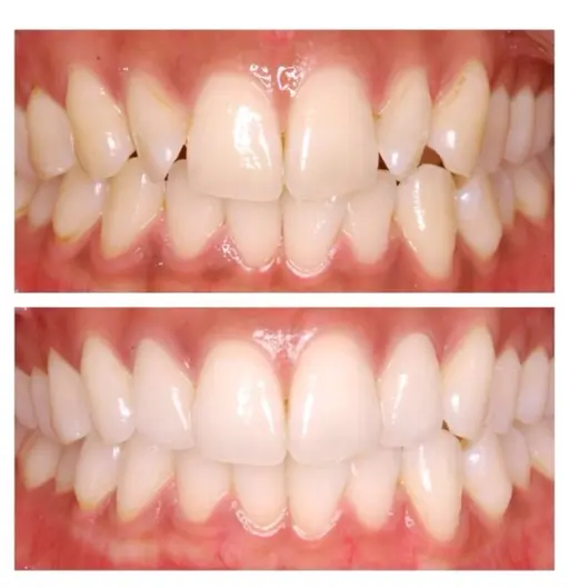 《セルフホワイトニング🦷✨》