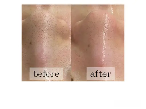 3月限定!!【毛穴欲張りメニュー】ハイドラ毛穴洗浄×イオン導入×顔脱毛