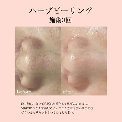 【2回目以降】ハーブピーリング