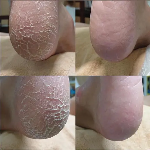 【カカト角質ケア】ガサガサ角質もツルスベに✨✨仕上がり大満足💁♀️◎