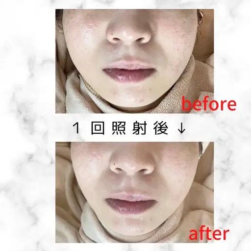 【顔】NPL方式 光フォト〈クレンジング+超音波角質洗浄+光フォト+シートマスク〉光フェイシャル 新規or会員