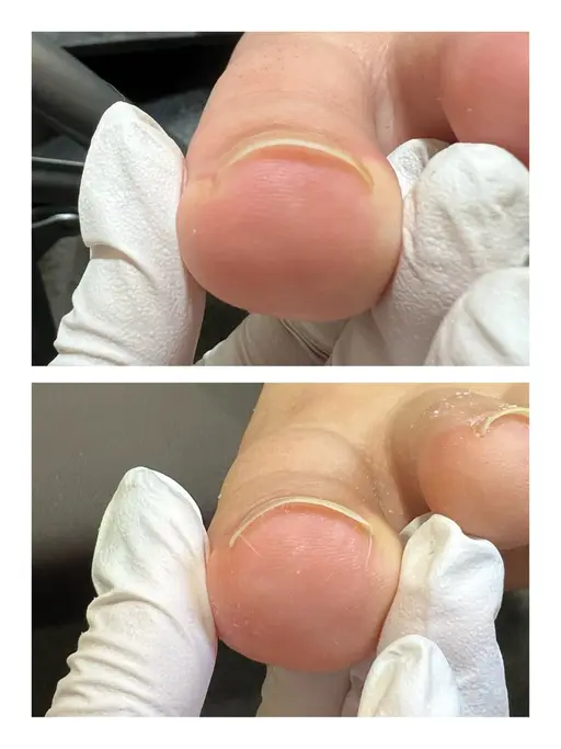 ⭐️ご新規様限定⭐️ 巻き爪【軽度】¥5,500※初診料別途