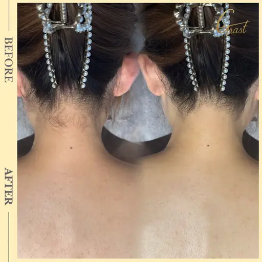 本当は気になる【自分では見えない後ろ】透明チャージ✨️背中うなじ脱毛★