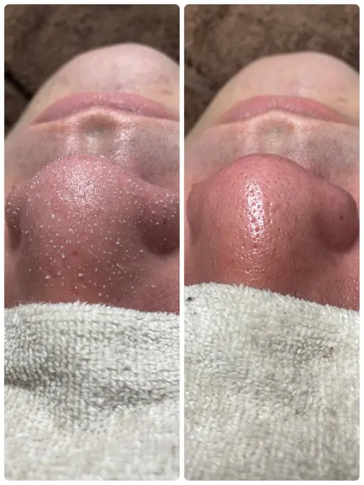 【メンズ肌向け◆毛穴黒ずみ◆ゴッソリ大洗浄】ハイドラ顔全体  8,800円→5,500円