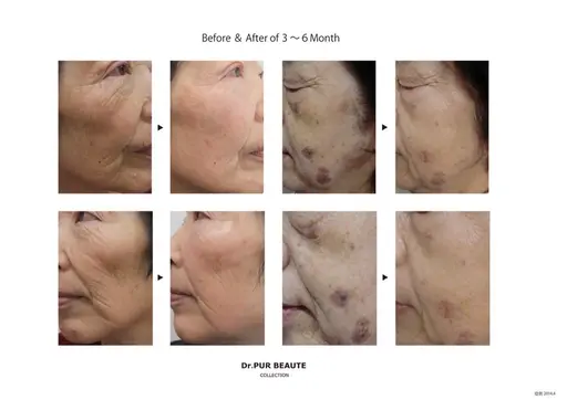 集中シミケア！代謝促進コース【2回分】