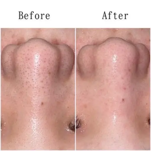 【初回限定】ハイドロ毛穴洗浄✨黒ずみ除去&つるん肌体験 通常¥7000→¥3900