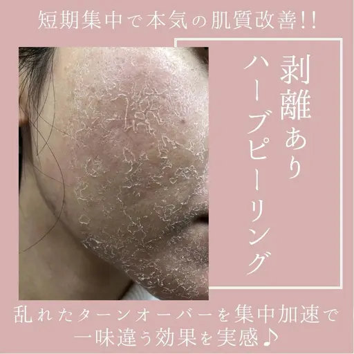 ♦️人気No.1♦️【剥離ありハーブピーリング•フェイス】ニキビ•ニキビ跡•毛穴◎すぐ実感！スペシャルハーブピーリング