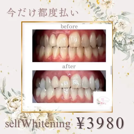 【効果絶大超ロング照射⭐️】1回限定ご利用可能クーポン🎶セルフホワイトニング60分¥7980→¥3980