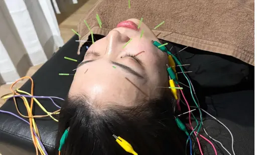 ✨お悩みに合わせた“効かせる美容鍼”✨ 【パルス美容鍼＋ポイントアプローチ】