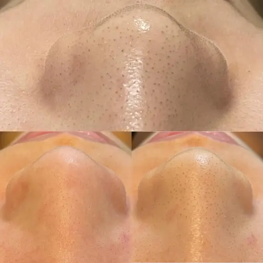 🌱初回限定。毛穴エクストラクション⭐️いちご鼻👃🍓【速攻実感✨毛穴改善】⚠️お鼻と1パーツお選びいただけます。