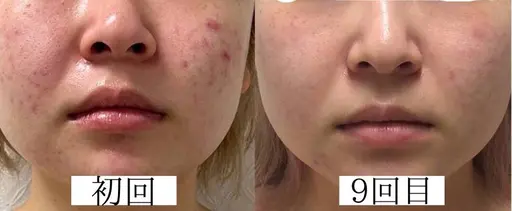 プラズマフェイシャル