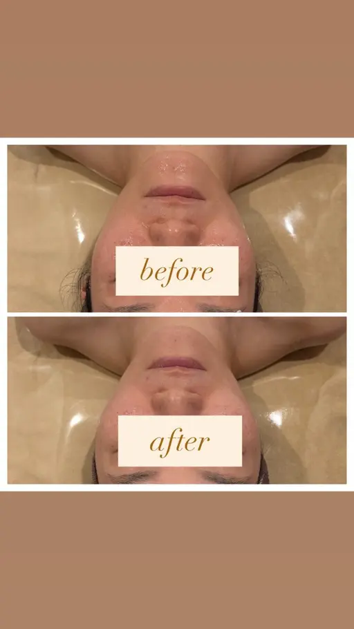 【𝐕𝐚𝐥𝐞𝐧𝐭𝐢𝐧𝐞 𝐦𝐞𝐧𝐮🍫2/1~2/28】 小顔EX×小顔コルギ×毛穴洗浄