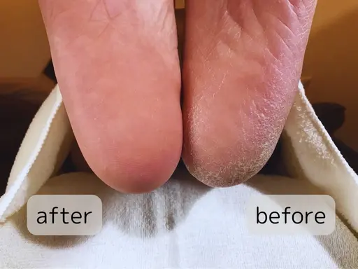 🦶フット角質ケア🦶ひび割れかかと、気になる指先まで✨足裏全体しっかりケアします！しっとりつるつるかかとに❣️