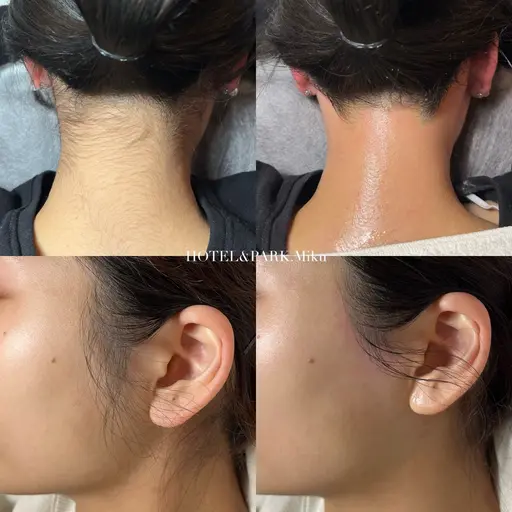 成人式前人気No.1👘40%OFF❤️【うなじ+もみあげワックス脱毛】