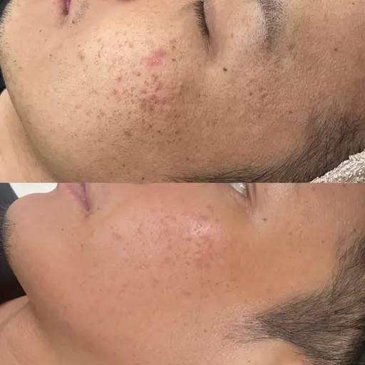 【土日祝限定】ハーブピーリング剥離あり🌿🥣