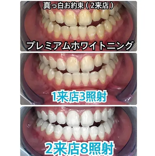 【初回限定・白さを極める】真っ白お約束🦷プレミアムホワイトニング❣️〈合計8回照射2来店〉❣️😌✨