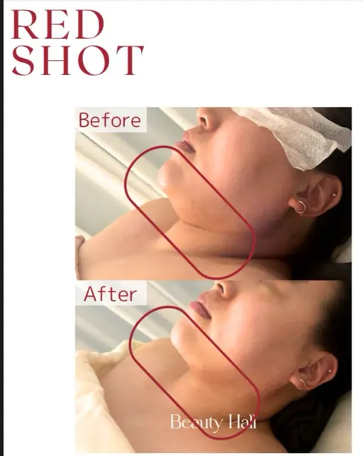 【韓国肌管理】【REDSHOT】韓国でブームの最先端施術!フェイスラインお試し!!