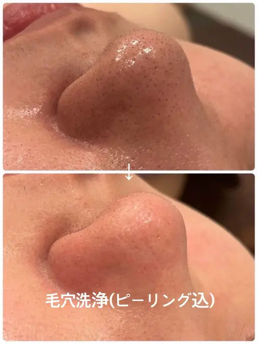毛穴洗浄（ピーリング込み）｜黒ずみ・角栓ごっそりケア