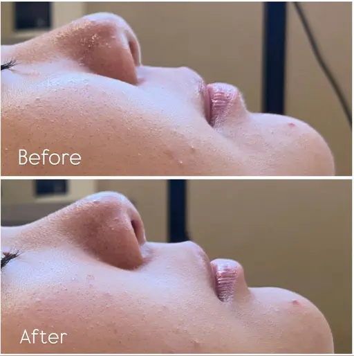 🫧フェイスシェービング🫧