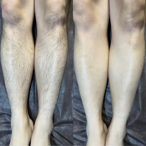 【VIO・顔・背中・両腕・両足】から好きな部位 2箇所 ¥5,800