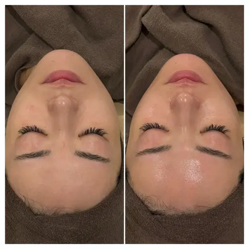 ツヤ爆誕⚡️第5世代ピーリング💆🏻‍♀️敏感肌の方も安心して受けられる陶肌ピール❣️ピーリングが初めての方にも◎