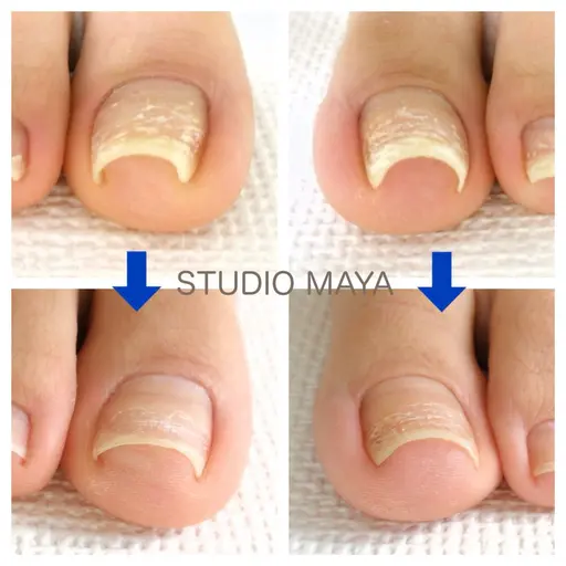 【foot】巻き爪ケア/BSブレイス【巻き爪・陥入爪補正】