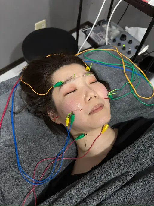 🤧花粉症にお悩みの方必見🔥花粉用鍼灸施術🤩