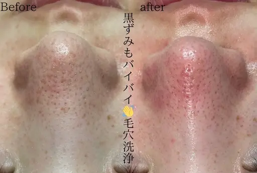 【初回限定】毛穴洗浄全顔コース　メンズにもおすすめ！